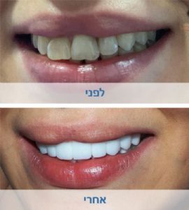 לפני ואחרי טיפול שיניים